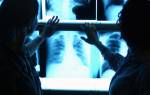Рентгеноскопия: показания для назначения и противопоказания