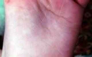 Коксаки: виды вируса, симптомы, методы лечения