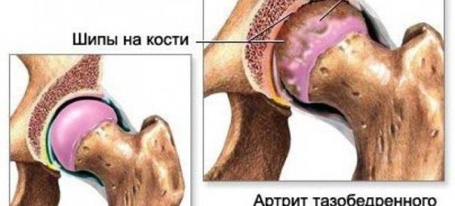 Кт бедренной кости: особенности проведения