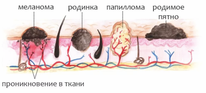 Электрокоагуляция кондилом: как проводится удаление