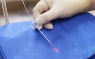 Лазерная коагуляция сосудов: операция, лечение и восстановление