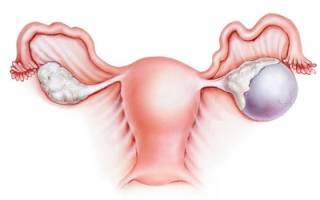 Удаление кист яичников: как проходит, последствия операции