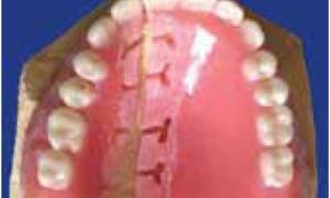 Коррекция зубных протезов: методы и особенности проведения