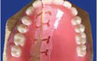 Коррекция зубных протезов: методы и особенности проведения