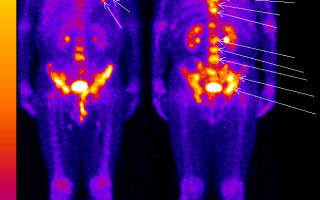 Сцинтиграфия костей: что это такое, показания и противопоказания