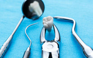 Удаление постоянного зуба: показания и противопоказания