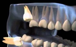 Удаление ретинированного зуба: последствия, что значит