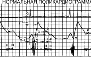 Поликардиография: преимущества и недостатки