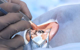 Склерэктомия: суть, ход операции, как подготовиться