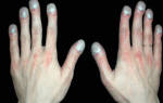 Изменение цвета ногтей: причины, симптом какой болезни