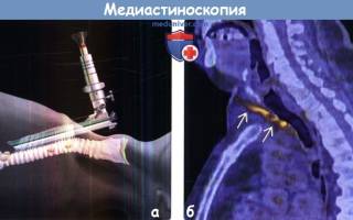 Медиастиноскопия: суть процедуры, показания, вред