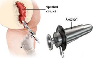 Аноскопия: как проводится и что показывает