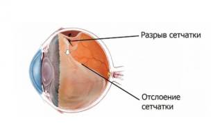 Лазерная коагуляция сетчатки глаза: как делается и когда назначается
