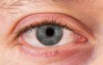 Сухие глаза: причины, симптомы, лечение