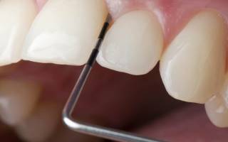 Кюретаж лунки удаленного зуба: противопоказания, рекомендации