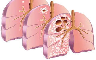 Здоровое питание при туберкулезе легких